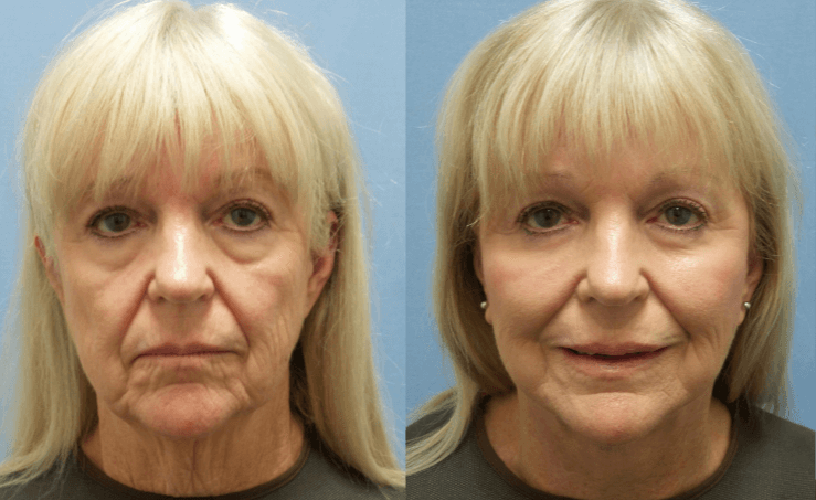 How Much is a Facelift? (And Why It's Worth It)