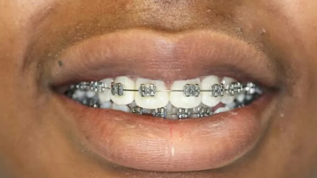 How Much are Braces