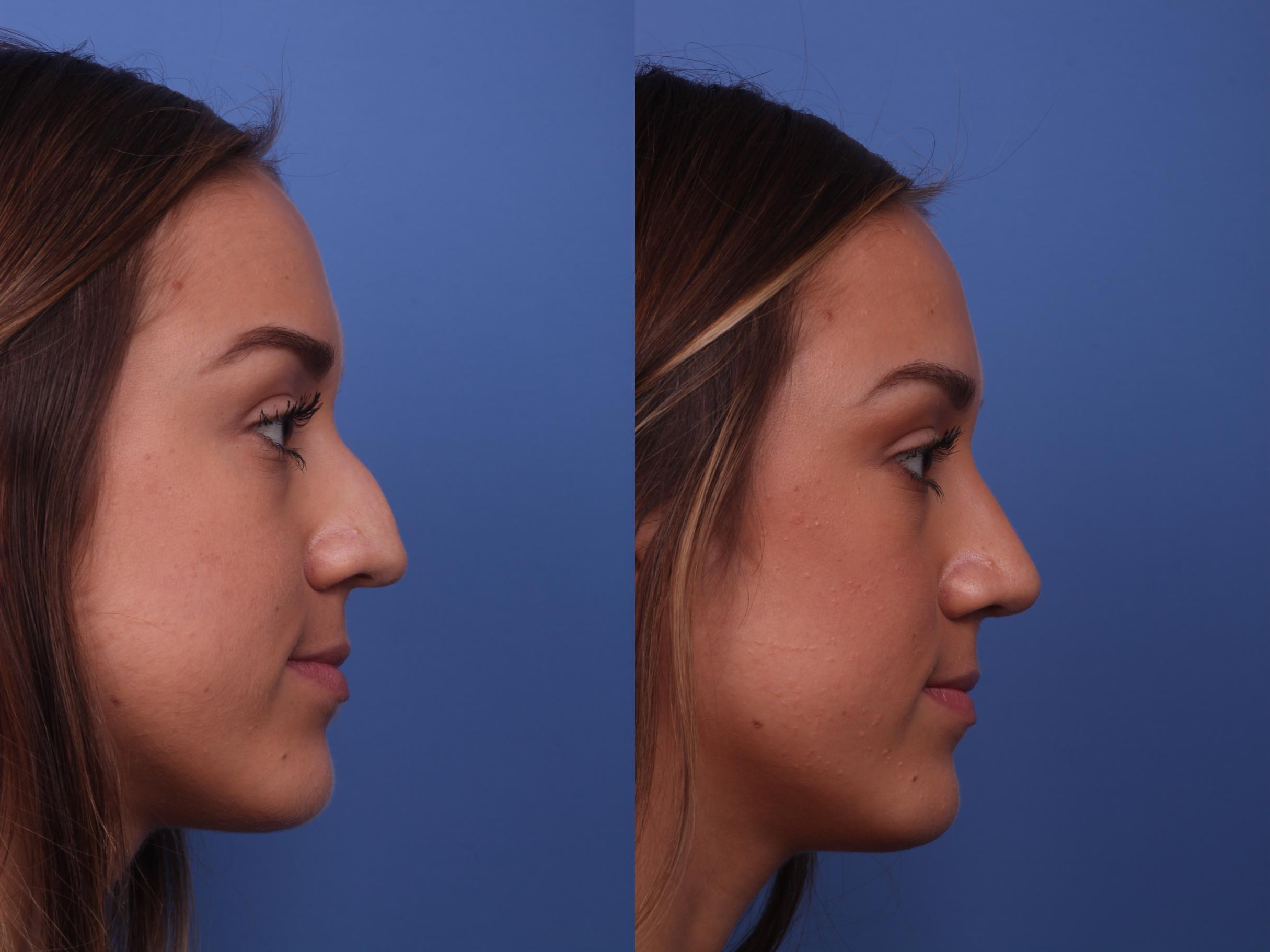 How Much is a Nose Job?